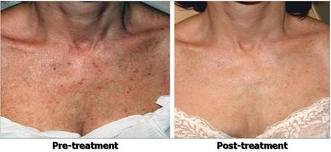 IPL_Pigmentation_Chest_Before_After