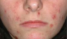 Ipl_before_acne
