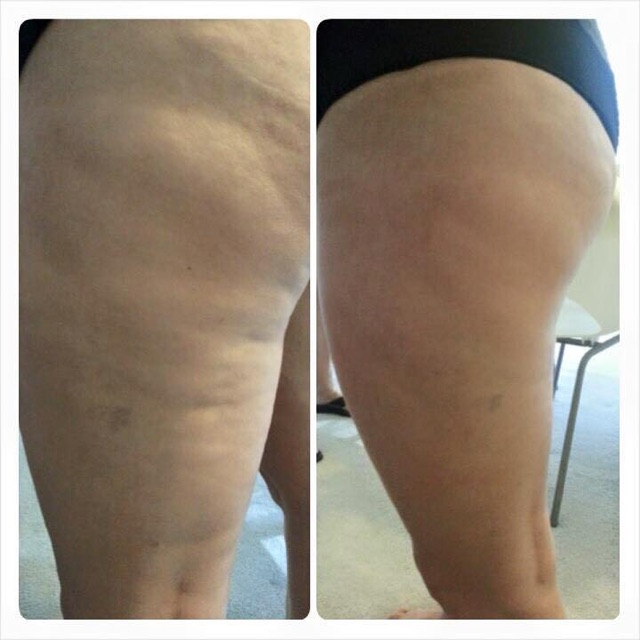 It_WorksTHIGHS_AFTER_1_TREATMANT