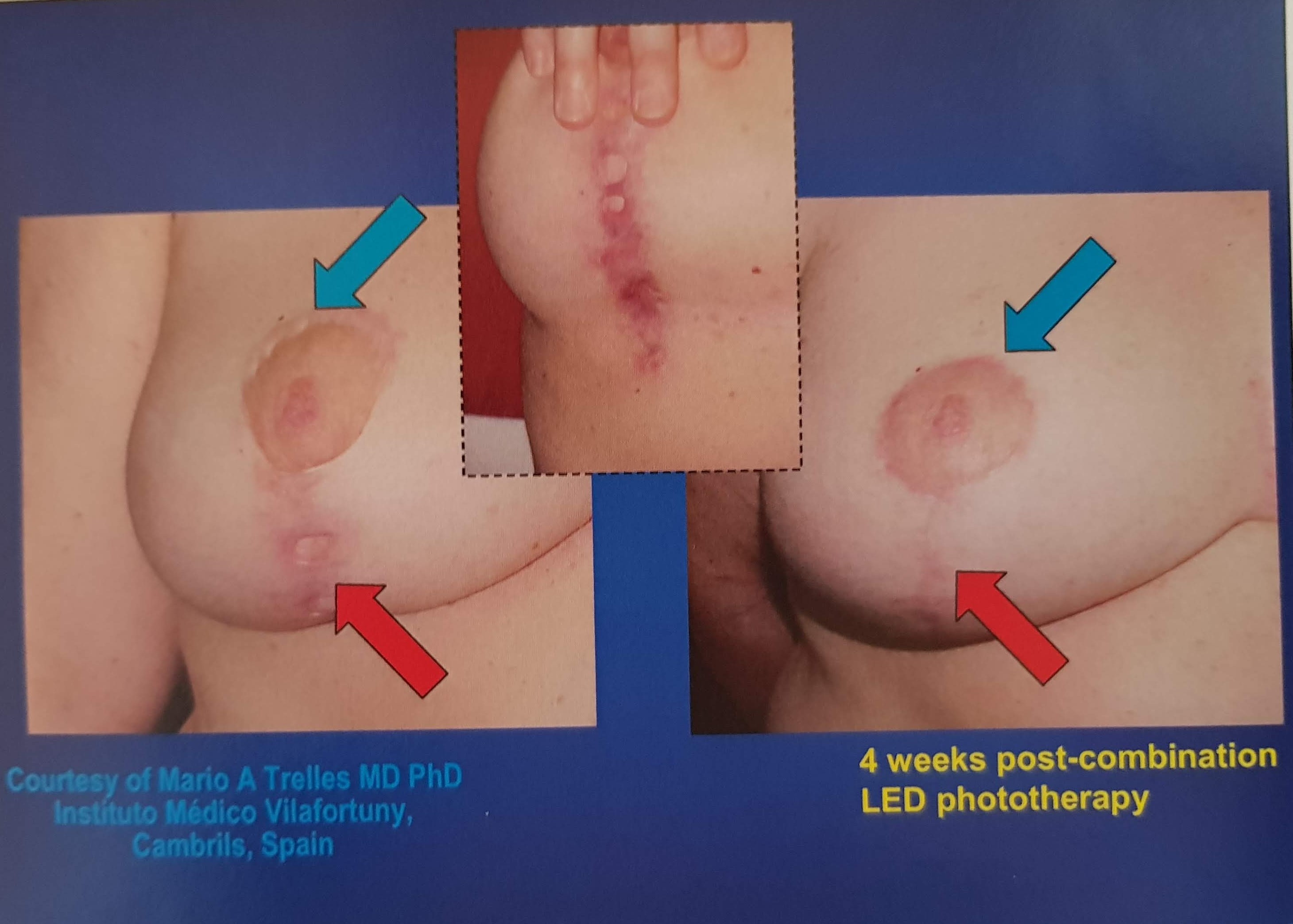 Omnilux_breast