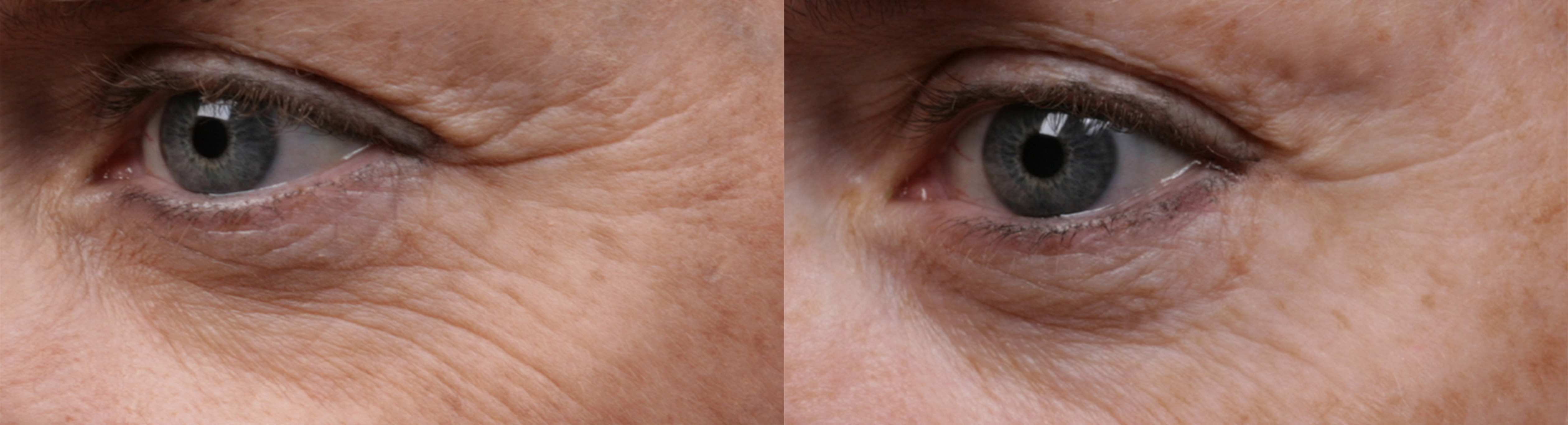 SilcSkin_Eyes_before_and_after
