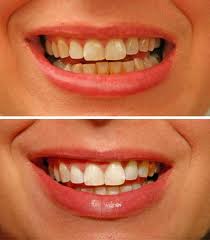 Teeth_before_and_after_2
